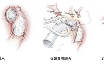 京健元一體化人工大血管，完成首例入組
